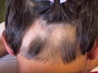 Saçkıran Kimlerde Görülür?