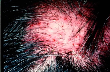 Saçkıran Nedir? Belirtileri ve Tedavisi